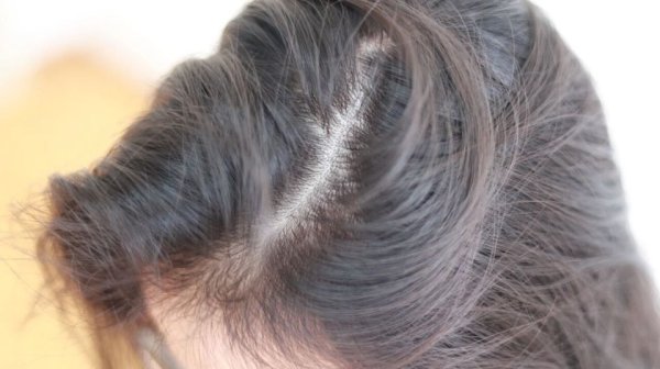 大象配资 3个不良生活习惯或会加重头屑问题，引起脱发，生活中请尽量避开